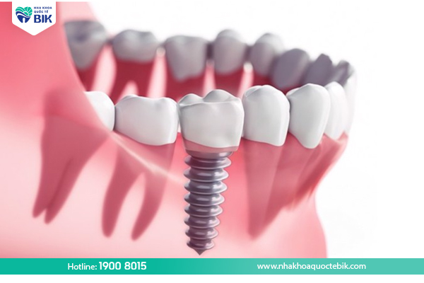 Trồng răng implant