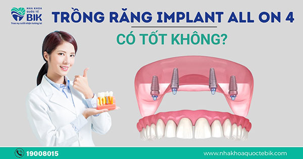 trong-rang-implant-all-on-4