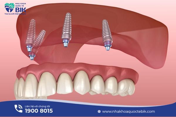 trong-rang-implant-all-on-4-co-tot-khong