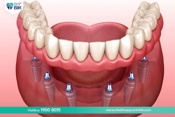 trong-rang-implant-all-on-6