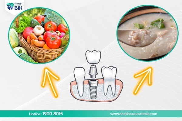 trong-rang-implant-bao-lau-thi-an-duoc