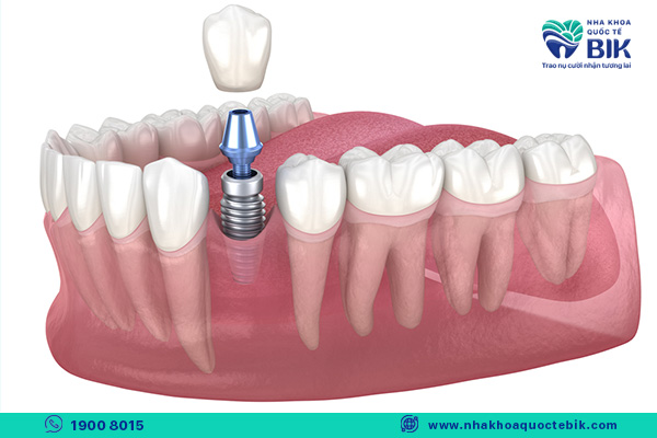 Because it is inserted directly into the bone, the implant is very durable