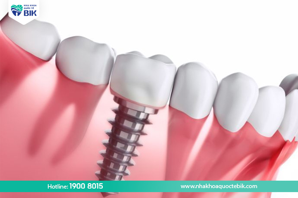 Implant tooth implant method