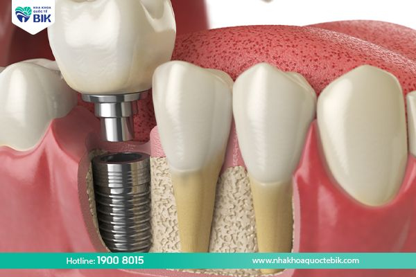 Trống răng implant to fix loose teeth