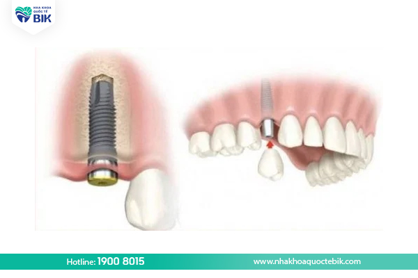 Implant dentistry to correct congenital tooth loss