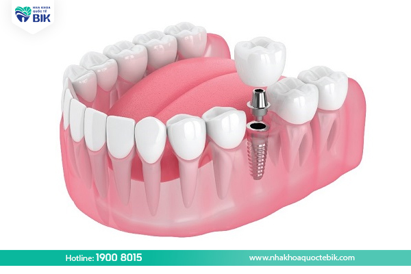 Trồng răng implant khi mất 1 răng hàm