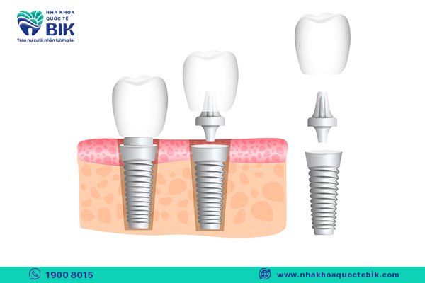 trồng răng implant là gì