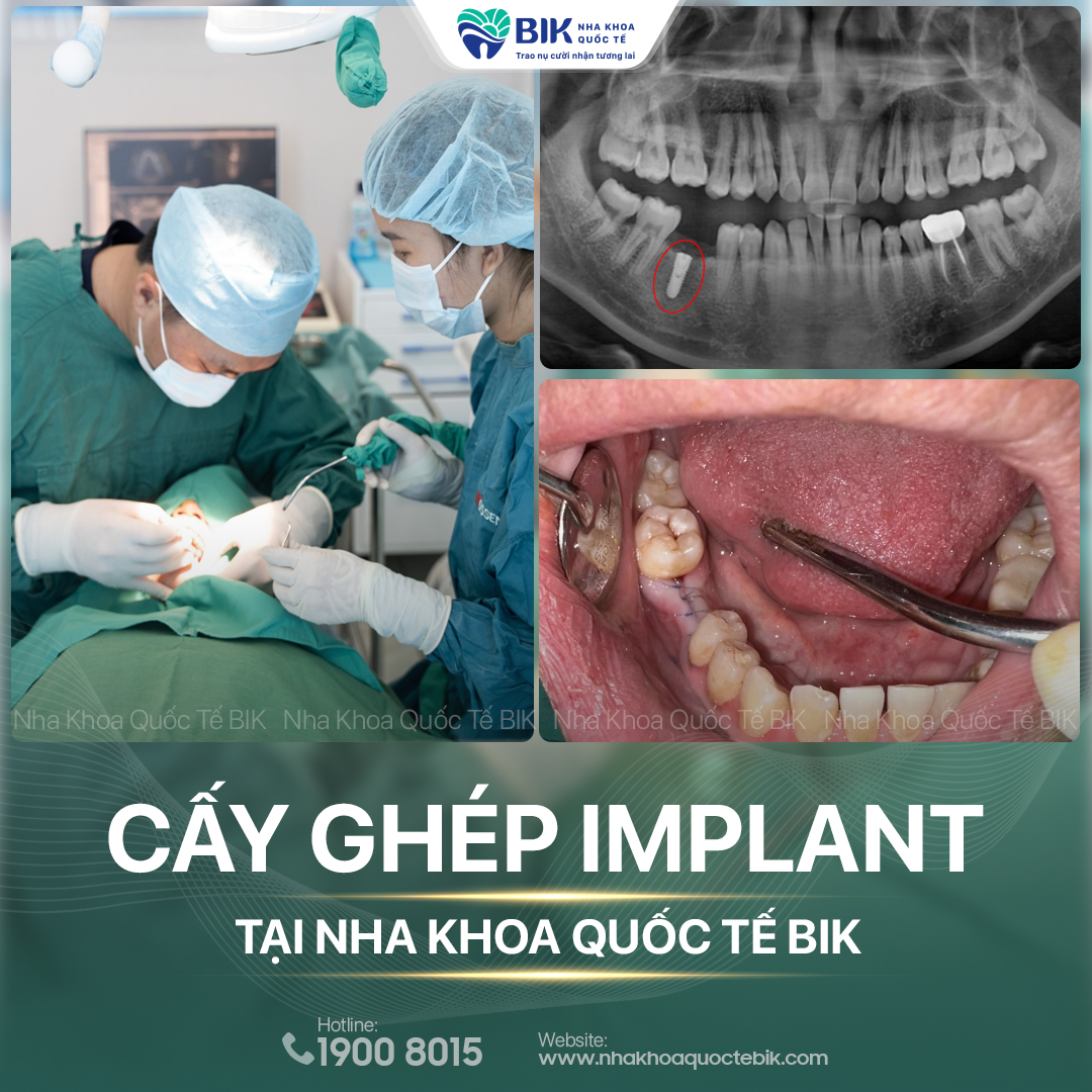 BIK International Dental Clinic - A good place for dental implants in Ho Chi Minh City