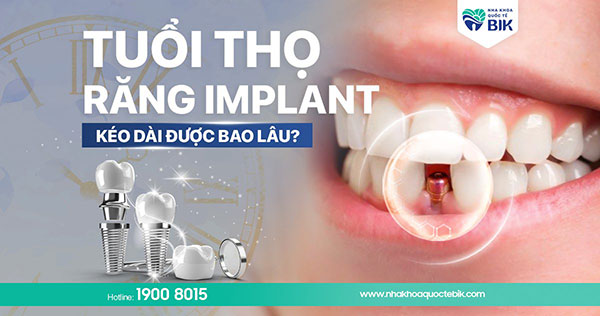 trong-rang-implant-giu-duoc-bao-lau