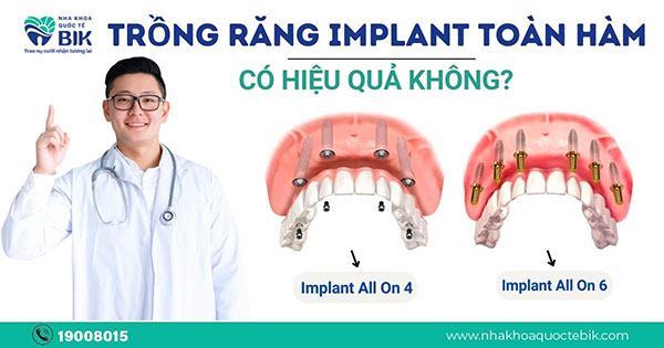 trong-rang-implant-toan-ham