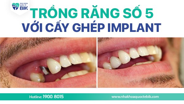 trong-rang-so-5-voi-cay-ghep-implant