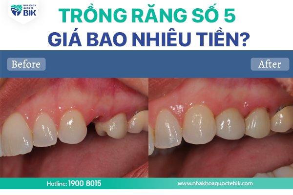 trong-rang-so-5-gia-bao-nhieu-tien