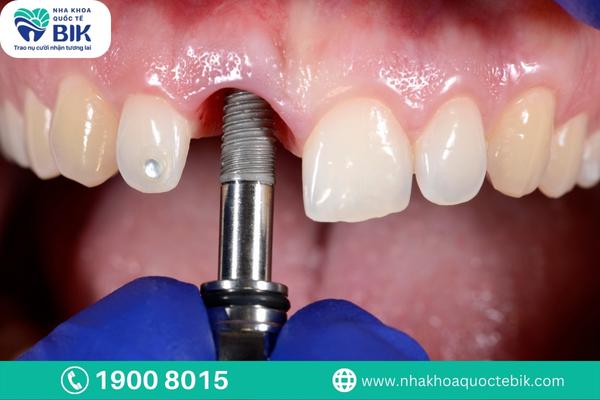 phuong-phap-trong-rang-implant-so-6-va-so-7