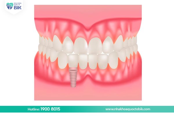 Trong-rang-cua-implant-bao-nhieu-tien