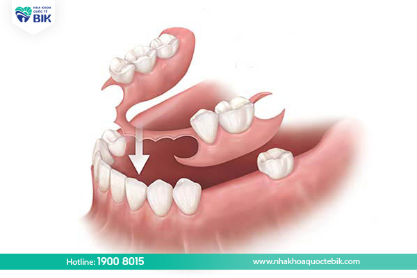 Trồng răng tháo lắp