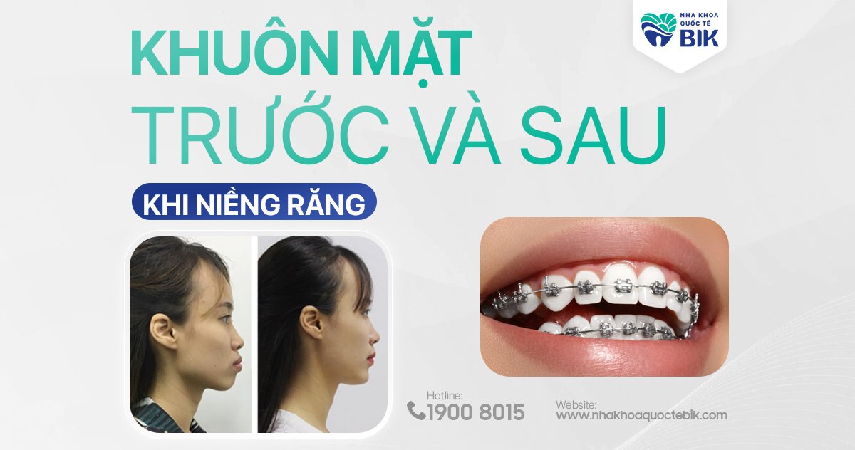 Trước và sau khi niềng răng