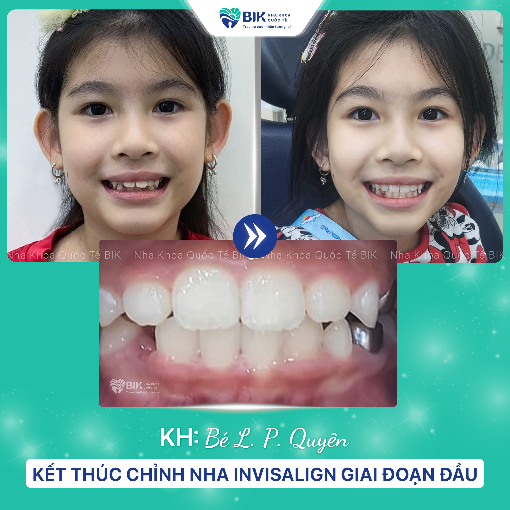 Changes in face before and after braces