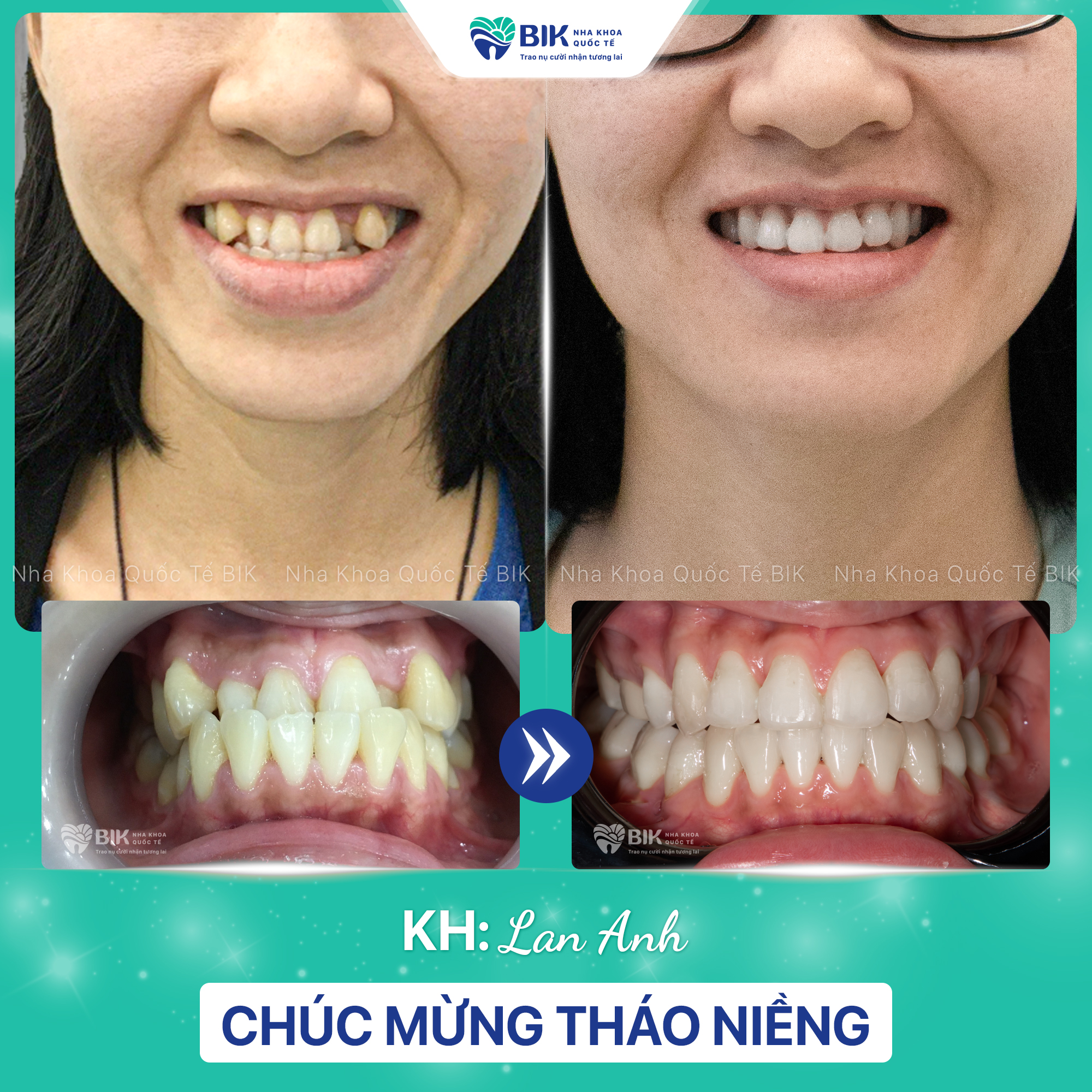 Thay đổi trước khi niềng răng