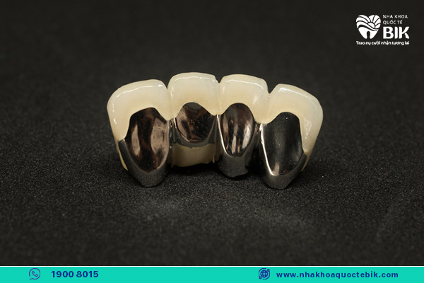 lifespan of metal ceramic teeth