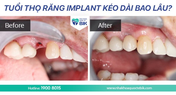 tuoi-tho-rang-implant