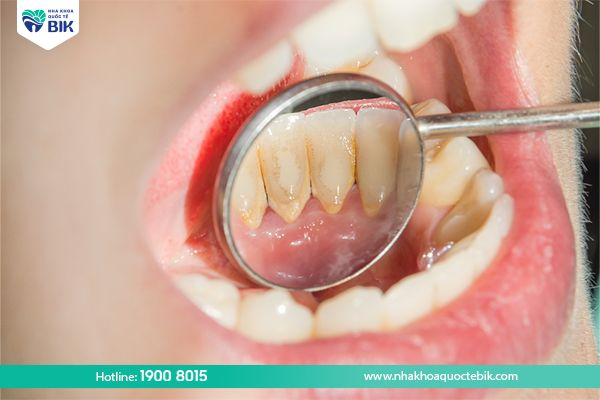 Receding gums lead to tartar formation