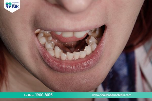 receding gums due to misaligned teeth