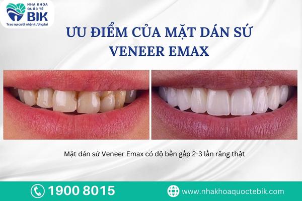 uu-diem-cua-mat-dan-su-veneer-emax