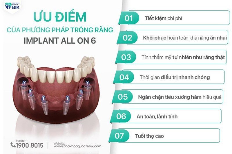 implant-all-on-6