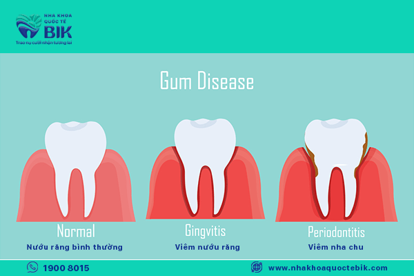 gingivitis causes periodontitis