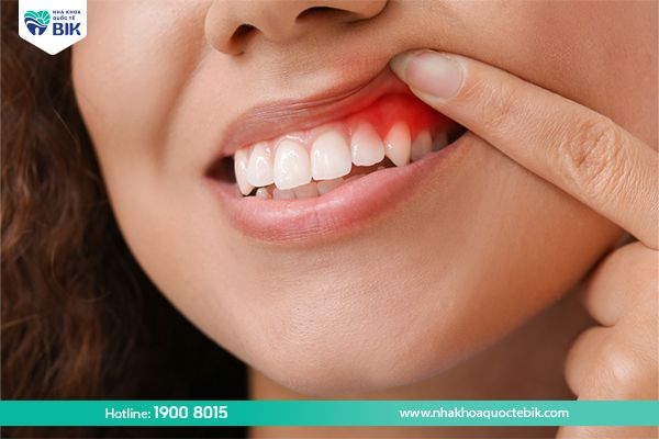 Gingivitis causes bleeding gums and bad breath