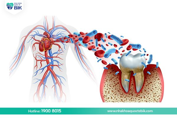 Viêm lợi trùm ảnh hưởng sức khoẻ toàn thân