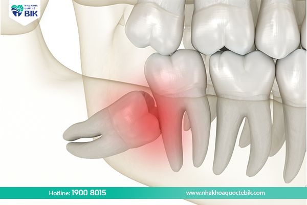 Gingivitis causes swollen gums