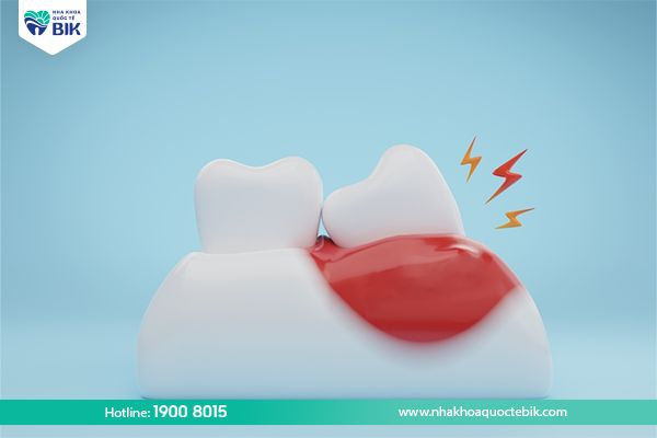 Pericoronitis causes gum infection