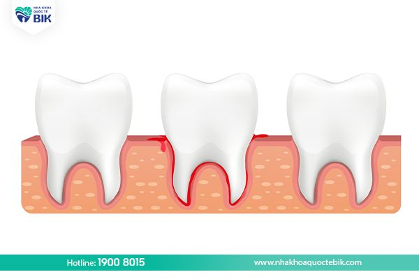 Periodontitis causes bleeding gums