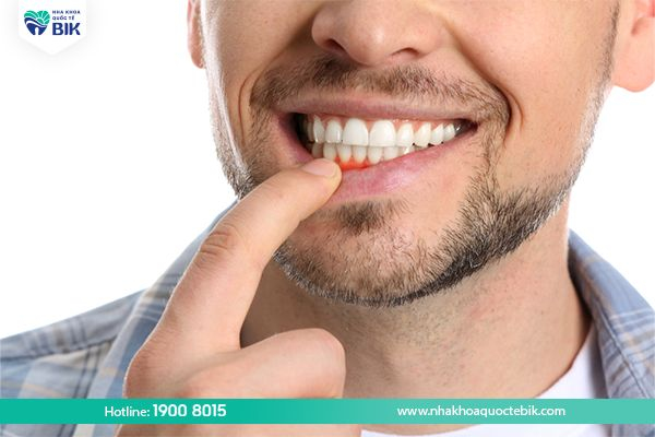 Periodontitis causes loose teeth