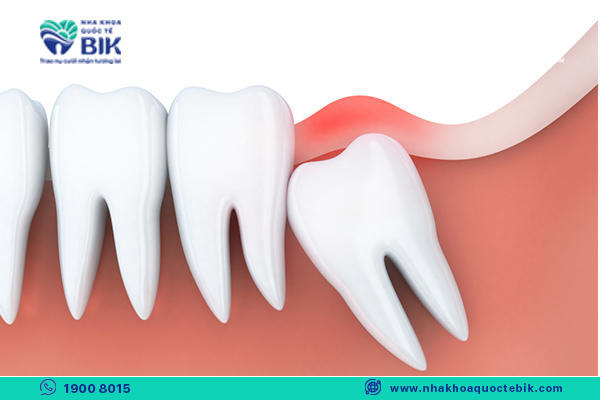 wisdom teeth with severe inflammation will be more painful to remove