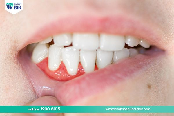 gingivitis leading to gum recession