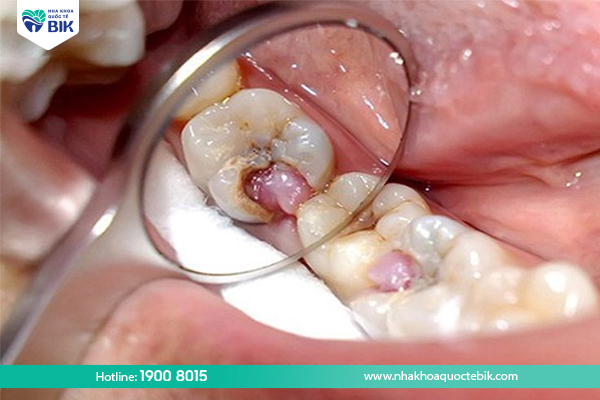 Tooth loss causes gingivitis, pulpitis