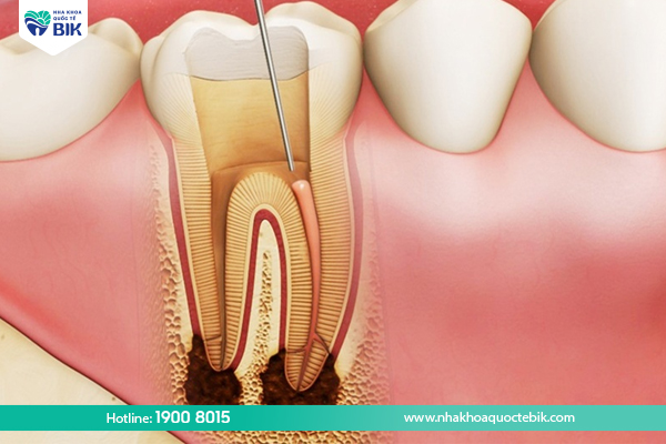 Tooth pulpitis - Causes of swollen tooth roots