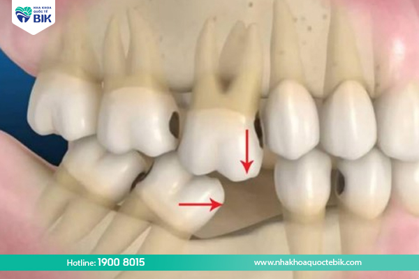 Losing a molar causes the adjacent teeth to shift