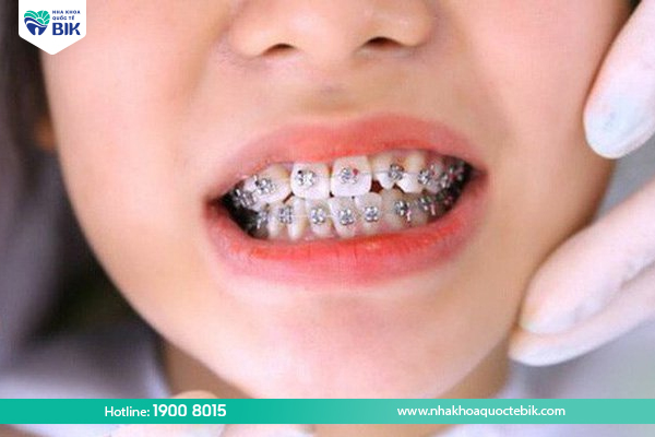 Factors affecting the price of braces for children