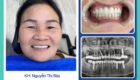 cấy ghép implant