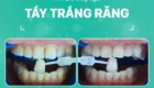 tẩy trắng răng