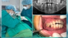 cấy ghép implant