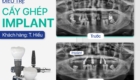 cấy ghép implant