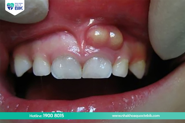 Periodontal abscess with a cavity