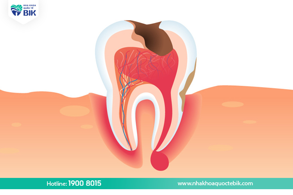 Causes of dental abscess