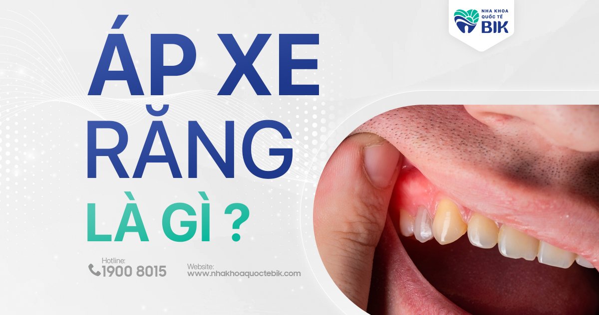 Áp xe răng là gì? Có nguy hiểm không? Cách điều trị tốt nhất