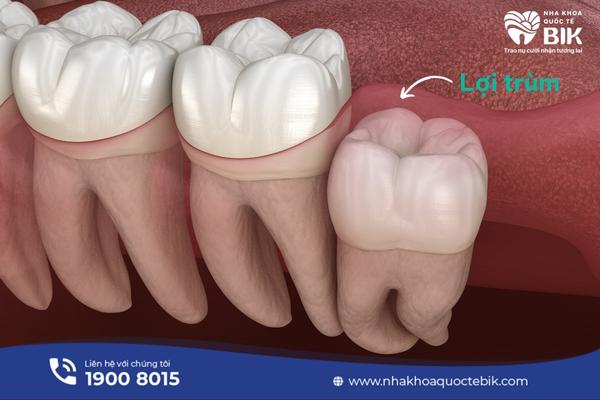 What is pericoronitis?