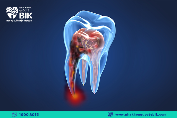 Is wisdom tooth extraction dangerous and what complications can occur